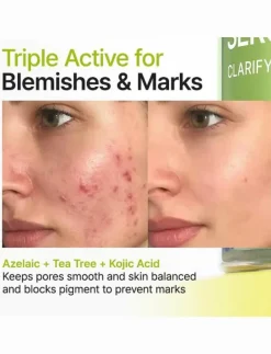 Azelaic Acid 10 Kojic Tea Tree Serum - Serum